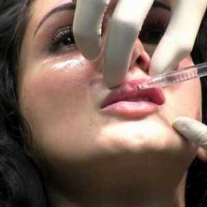 Биополимер на устните: последствия, прегледи