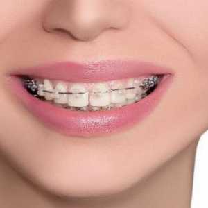 Болезнено ли е да поставяте скоби на зъбите си? Описание на процедурата