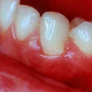 Какво е лечението на заболяването на венците? Полезни съвети