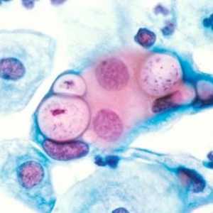 Chlamydia trachomatis. Какво е това и какви заболявания причинява?