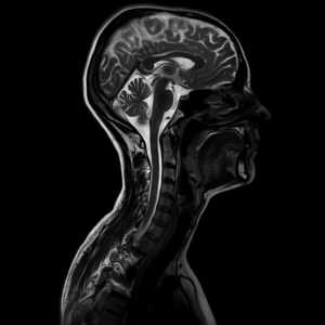 Какво показва MRI на шията? ЯМР на лимфни възли, съдове и меки тъкани на шията