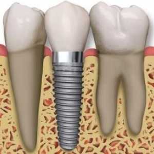 Какво препоръчват зъболекарите, когато има нужда от поставяне на зъби?