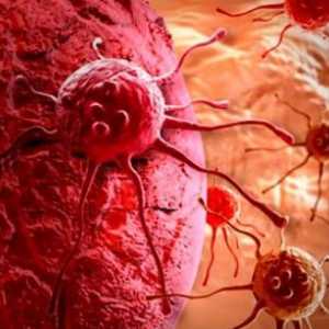 Какви са метастазите при рака? Злокачествен тумор и метастази