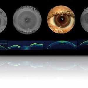 Какво представлява оптичната кохерентна томография на окото?