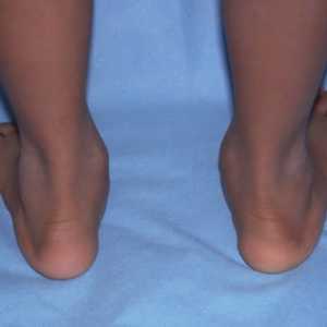 Какви са плоските крака на децата и как да ги лекувате