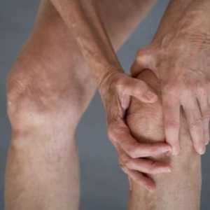 Деформиране на артрозата на колянната става 2 градуса: лечение и причини