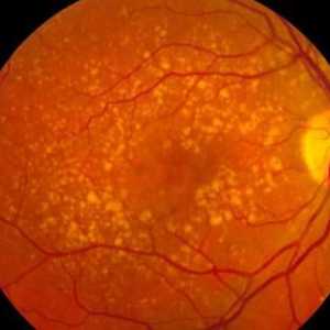 Дегенерация на макулата ретина: симптоми и лечение