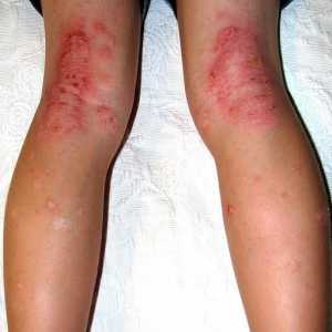 Дерматит по краката: причини и лечение