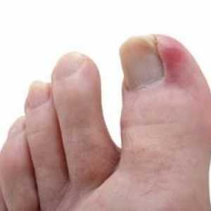 Доста често срещано явление - ноктите растат по краката. Какво да направя в този случай?