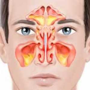 Двустранен синузит: симптоми и лечение