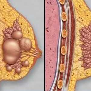 Фиброза на млечните жлези: диагноза и лечение