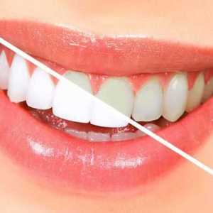 Флуорирането на зъбите - какво е това? Как се извършва процедурата на дълбока флуоризация на зъбите?