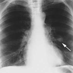 Hamartoma lung: причини, симптоми, лечение