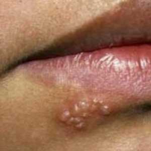 Херпес на устните: как се предава? Лек за херпес на устните. Опасен ли е херпесът?