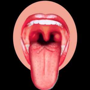 Херпес на езика. Причини и лечение на болестта