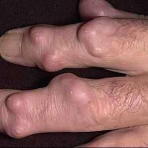 Hygroma на пръста: да се премахне или не?