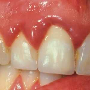 Гингивит: какво да изплакнете устата си с възпаление на венците?
