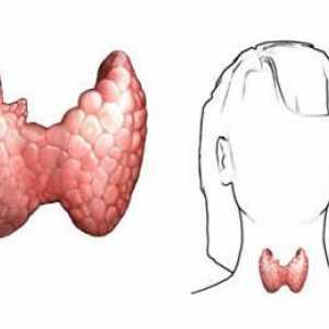 Хипертиреоидизъм на щитовидната жлеза: причини, симптоми, диагноза, лечение