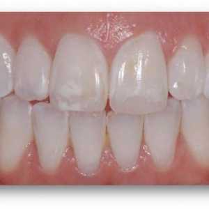 Хипоплазия на зъбния емайл: диагноза и лечение