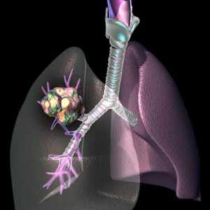 Химиотерапия за рак на белите дробове. Как да се лекува рак на белия дроб