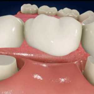 Имплант или мост - кое е по-добре? Зъбни импланти. Зъбна протеза