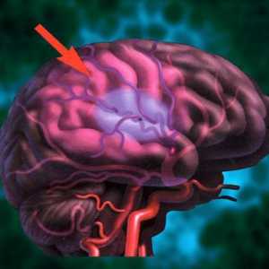 Ход на мозъка: превенция. Народни средства за профилактика на инсулт
