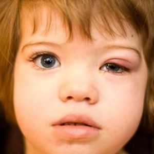 Ечемик при деца: причини, симптоми, лечение