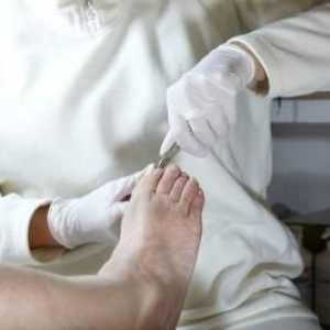 Ефективно лечение на врастнали нокти на краката
