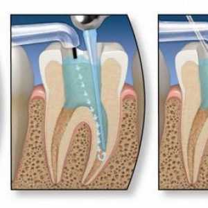 Ендодонтско лечение на зъбите. Етапи на ендодонтско лечение