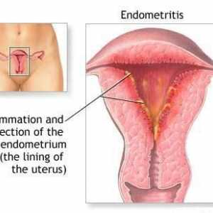 Ендометрия на матката - какво е това? Симптомите на ендометрията при жените. Гинекология -…