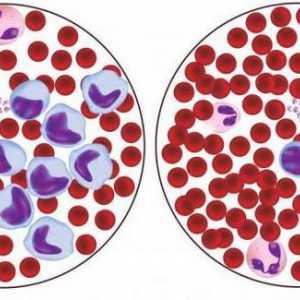 Еритетроцитите в кръвта се понижават: възможни причини