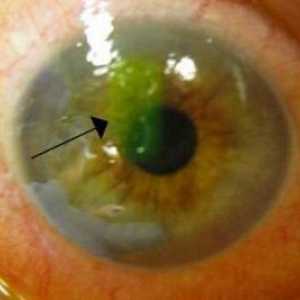 Ерозия на роговицата на окото: симптоми, причини и лечение