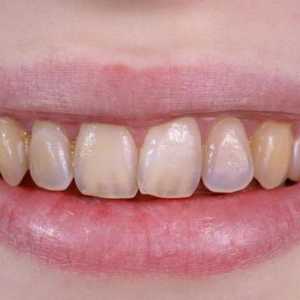 Ерозия на зъбите: описание, причини, симптоми и особености на лечението