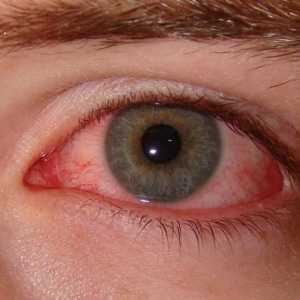 Как да се отървете от синдрома на сухото око?