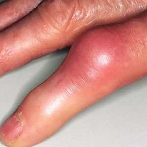 Как да се лекува народна лекарства възпаление на ставите на пръстите