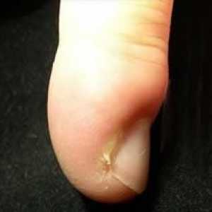 Как да се лекува абсцеси на пръстите: различни терапии