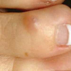 Как да се третира сухият калус на пръстите? Мазилка върху сухи корнизи