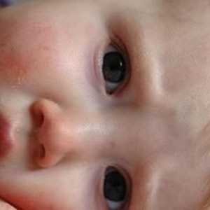 Как се лекува атопичният дерматит при дете?