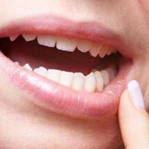 Как да премахнете набъбването след отстраняването на зъба на мъдростта?