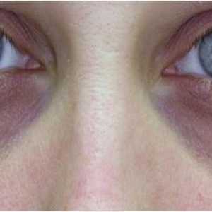 Как да почистите синините под очите? Разглеждаме ефективни методи