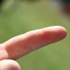 Как да измъкнем пръчиците от пръста си? Добър съвет