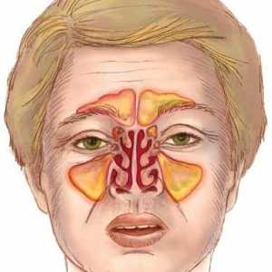 Какви са симптомите на синузита? Лечение на заболяването