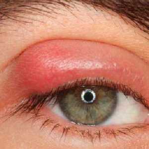Капки от ечемик на окото: избор на правилното лекарство, инструкции