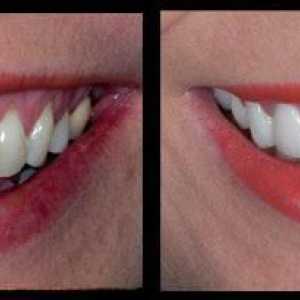 Керамични коронки на предните зъби