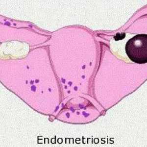 Цист на десния ендометриозен яйчник: симптоми и лечение