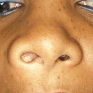 Киста в носа - опасно ли е? Лечение на кисти с народни средства