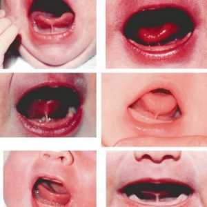 Кратка френума на езика на детето: струва ли му се да се реже?
