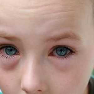 Червени очи при децата - възможност да се обърнете към офталмолог