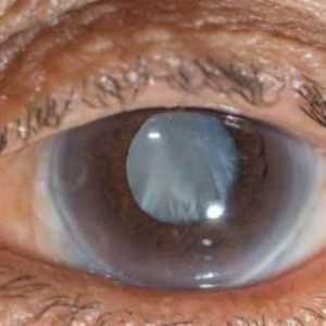 Лечение на началния стадий на катаракта. Първите признаци на начална катаракта