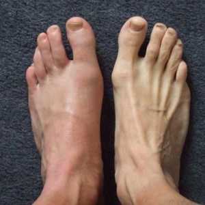 Лечение на подагра на краката: основни принципи